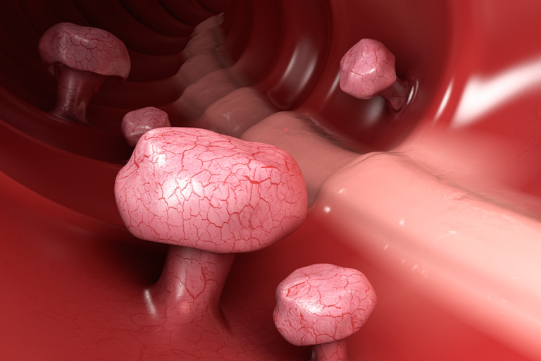 この3 つの異常は腸がんを示している可能性がある