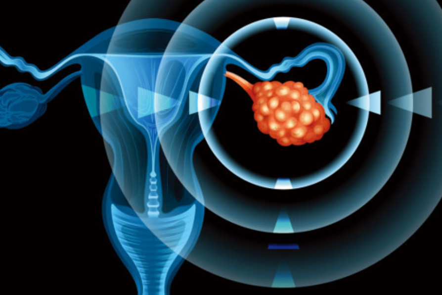 卵巣癌の多くは末期に発見され、主にこの3つの原因である